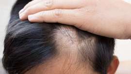 Cristina Morante, directora médica de la clínica MC360, nos da las claves sobre por qué España es el segundo país del mundo con más índice de alopecia