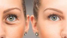 Ahora que los ojos son tan importantes en la estética del rostro, donde destacan más que nunca por el uso de mascarilla, la presoterapia es un aliado perfecto para borrar de un plumazo bolsas y ojeras 