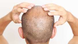 Según la dermatóloga Cristina Zemba de la SESMI, existe una posible relación entre los andrógenos y la Covid-19