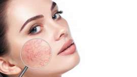 Una de las afecciones cutáneas que más sufren las bajas temperaturas y otras condiciones físicas y de temperatura es la rosácea. IML enumera causas y efectos y los tratamientos más eficaces de la medicina estética y dermatología