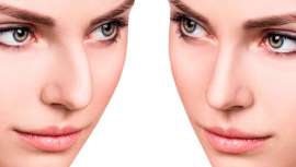 Actualización de la técnica quirúrgica gracias a la incorporación del bisturí ultrasónico, que permite intervenir tanto las partes duras como las partes blandas de la nariz, con máxima precisión y mínimo traumatismo