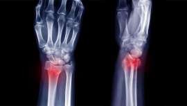 330.000 fracturas por fragilidad, y una previsión en aumento, ponen el acento en la prevención y el seguimiento del tratamiento 