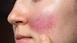 Enfermedad inflamatoria crónica y recurrente de la piel, que los Laboratorios OzoAqua proponen combatir a través de un infalible protocolo