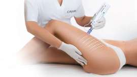 La firma, 45 años de cuidado de la piel, presenta dos protocolos, reductor y reafirmante, respectivamente, que en sinergia con la técnica del microneedling proporcionan resultados desde la primera aplicación