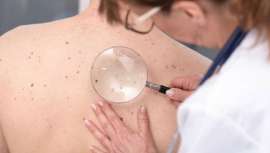 Un programa que sigue el tratamiento oral de determinados pacientes con melanoma desde su casa