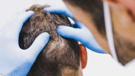 Óscar Mendoza, CEO de Hospital Capilar, analiza la situación actual del injerto capilar en nuestro país y señala las bases para convertir a España en el principal mercado receptor para estos pacientes, cada vez más numerosos 