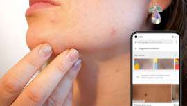 El gigante Google anuncia que ofrecerá nuevas funciones de inteligencia artificial para ayudar a los usuarios de Internet a identificar sus problemas cutáneos, recomendándoles tratamientos