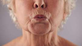 Estas arrugas se producen como consecuencia de la edad y la deshidratación, además de malos hábitos como el tabaquismo o el alcohol