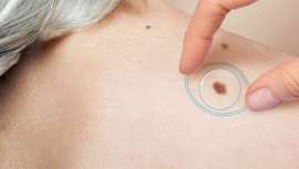 Iniciativa y producto de DermTech que identifica el cáncer de piel, que sale al mercado junto a la campaña #Stickit2Melanoma de prevención y concienciación sobre la vital importancia de la detección precoz y la salud de la piel