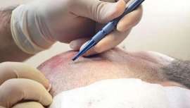 Trasplante capilar FUE con cuchillas de zafiro que asegura un cabello más natural y denso y menor tiempo de recuperación y efectos secundarios