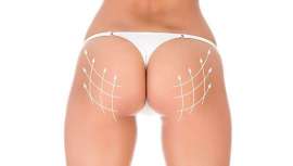 La doctora Victoria Páez tiene claro que un 40% del volumen se concentra en la mitad superior del glúteo y el 60% en la inferior