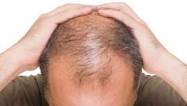 Según distintos estudios, además, las españolas son las europeas que más cabello pierden. La farmacéutica Teresa Climent, responsable de comunicación de Nuggela & Sulé, nos explica cómo se produce y cómo evitar la alopecia