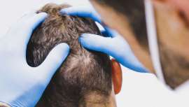 Este tratamiento aumenta el grosor y la textura del pelo, evitando su caída. Carece de reacciones adversas y no produce alergias al tratarse de plaquetas del propio paciente, mejorando las cualidades del cuero cabelludo y del propio cabello