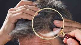 La pérdida de pelo más relacionada con la ansiedad o el estrés suele ser el efluvio telógeno o alopecia nerviosa, en la que se altera el ciclo vital de los folículos pilosos, provocando el paso abrupto de la fase anágena a telógena