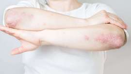 Es el último descubrimiento científico con resultados más que esperanzadores en pacientes con psoriasis