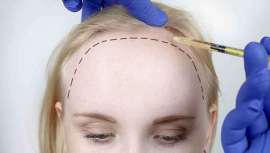 Ante la pérdida de cabello o calvicie este tratamiento se plantea como el más eficaz para acabar con un problema que afecta a un gran número de la población. Solo hay que decidirse por la técnica más adecuada