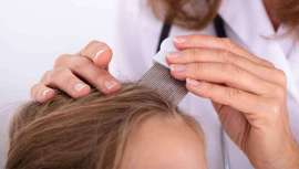 Aunque los tratamientos con pediculicidas, o tratamientos para eliminar los piojos, no se recomiendan hasta la aparición de los mismos, bien es cierto que la utilización de algunos activos naturales con estas propiedades puede ayudar a evitarlos