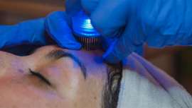 Imperium Med 400 adopta la técnica exclusiva con el manípulo RF fraccionada. Consigue unos resultados marcadamente mejores con respecto al uso de otras técnicas como el microneedling, rodamiento con agujas o láser fraccionado