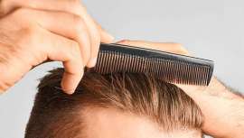 Según el doctor Pilo de la clínica Hospital Capilar, el Shock Loss es un proceso natural y reversible que consiste en la caída de pelo postraumática derivada del trasplante capilar