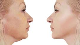 ¿Es posible eliminar la papada con criolipólisis médica? Esa antiestética acumulación de grasa tiene solución. CoolSculpting Elite y sus aplicadores en varios tamaños hacen posible tratar la temida grasa mediante la aplicación de frío