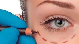 La oculoplastia corrige un defecto ocular, por ello no debe entenderse como una cirugía estética, sino como una solución oftalmológica