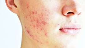 Uno de los más visibles, describimos qué es el acné papulopustuloso y cuál es su tratamiento