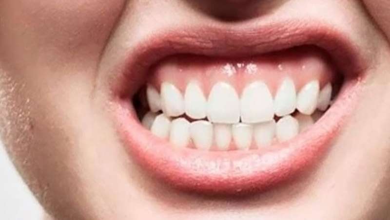 Todo sobre el bruxismo, la enfermedad silenciosa