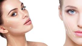 Lo último para mejorar la flacidez y el descolgamiento facial