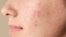 Alrededor de 23 millones de personas en Europa padecen esta enfermedad. Ahora, y durante el simposio de primavera de la EADV, dermatólogos alemanes descubren la relación entre acné y falta de Omega-3