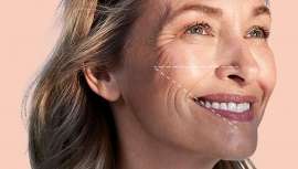 Sin incisiones que puedan verse, sin tiempo de recuperación y sin miedo a un resultado poco natural