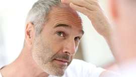 Está revolucionando los titulares y a los calvos. La pastilla milagro contra la calvicie