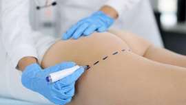 La medicina y cirugía estética pone al alcance de sus pacientes los glúteos de moda. Revisamos con los expertos de Clínica Opción Médica los actuales procedimientos y técnicas del aumento de glúteos