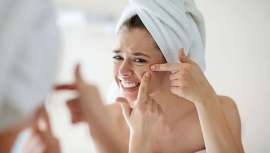 La facialista Arancha Sevillano explica de qué manera cuidar y prevenir el acné en la época estival 