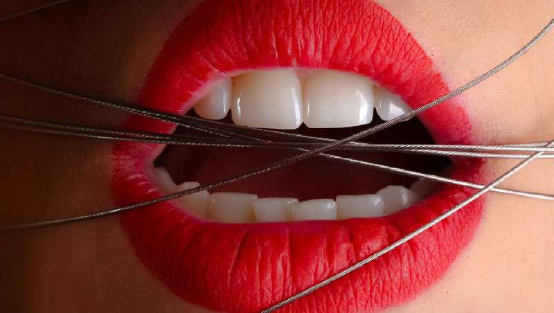 Desgaste dental: de qué manera prevenirlo