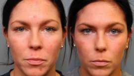 El primer cuidado de la piel que utiliza un descubrimiento ganador del Premio Nobel para desafiar el envejecimiento, corrigiendo la piel arrugada y dañada, con hasta 70 aplicaciones por producto