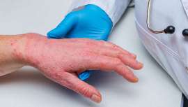 En el próximo congreso de la EADV que se va a celebrar en Milán, esta alteración de la piel es protagonista en distintas sesiones