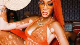 El Dr. Juan Jiménez Cahué, dermatólogo de Clínica FEMM, explica los datos más relevantes de esta enfermedad, un trastorno cutáneo que provoca manchas blancas y desiguales en la piel del paciente