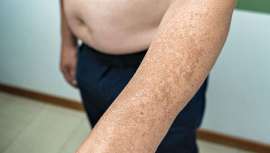 GEDET (Grupo Español de Dermatología Estética y Terapéutica) de la AEDV y sus especialistas dermatólogos analizan las hiperpigmentaciones de la piel