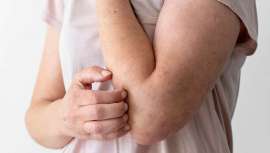 El 14 de septiembre se celebra el Día Mundial de la Dermatitis Atópica y te presentamos los 8 consejos básicos, junto a una serie de recomendaciones, para minimizar los efectos de esta enfermedad inflamatoria de la piel