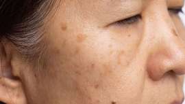 El melasma supone un reto para el especialista médico pues es difícil de tratar y necesita un buen diagnóstico por parte del profesional y un tratamiento individualizado. Según los estudios, el 90% de los pacientes son mujeres jóvenes