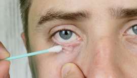 Este ácaro microscópico (no se ve a simple vista) vive en el folículo de las pestañas y cejas y se alimenta de las células muertas de la piel