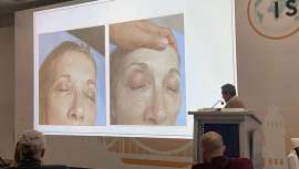 Los fórmula 1 de la micropunción llevan apellido valenciano y así lo ha demostrado el doctor Gabriel Serrano en ISAPS, Congreso de la Sociedad Internacional de Cirugía Plástica