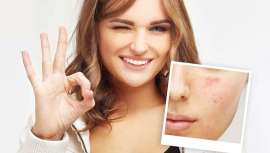 Tanto si se trata de acné desde la adolescencia como si es una novedad de la edad adulta, el tratamiento adecuado existe. Todo lo que queda es encontrar los mejores principios activos para combatir esta afección cutánea