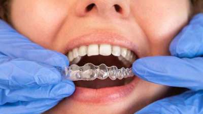 Los peligros de los tratamientos low-cost en ortodoncia invisible