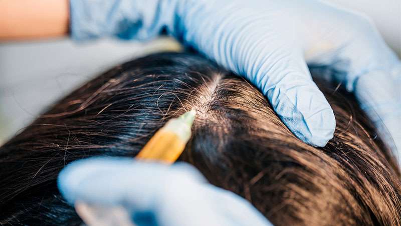 Plasma rico en plaquetas que trata la alopecia en hombres y mujeres