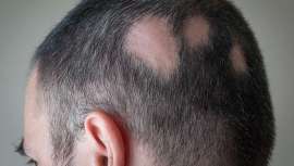 En este tipo de alopecia el sistema inmunitario no reconoce a los folículos pilosos como suyos