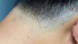 El dermatólogo malagueño José Ignacio Galvañ asegura que esta enfermedad contagiosa tiene el nexo común de producirse entre varones que se rapan con la estética slicked back varias veces al mes