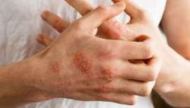 Reproducimos lo más destacado del simposio patrocinado por Sanofi y Regeneron Pharmaceuticals durante el congreso de la Academia Europea de Dermatología 2022