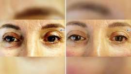 La Dra. Cristina Chacón, experta en medicina estética y CEO del centro CCH Privé de Madrid, es uno de los doctores en España que emplean esta exclusiva técnica