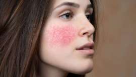 Si quieres saber cuánto dura un brote y cómo calmarlo, las doctoras Pérez Sevilla y Arantxa Arana te dan todas las respuestas